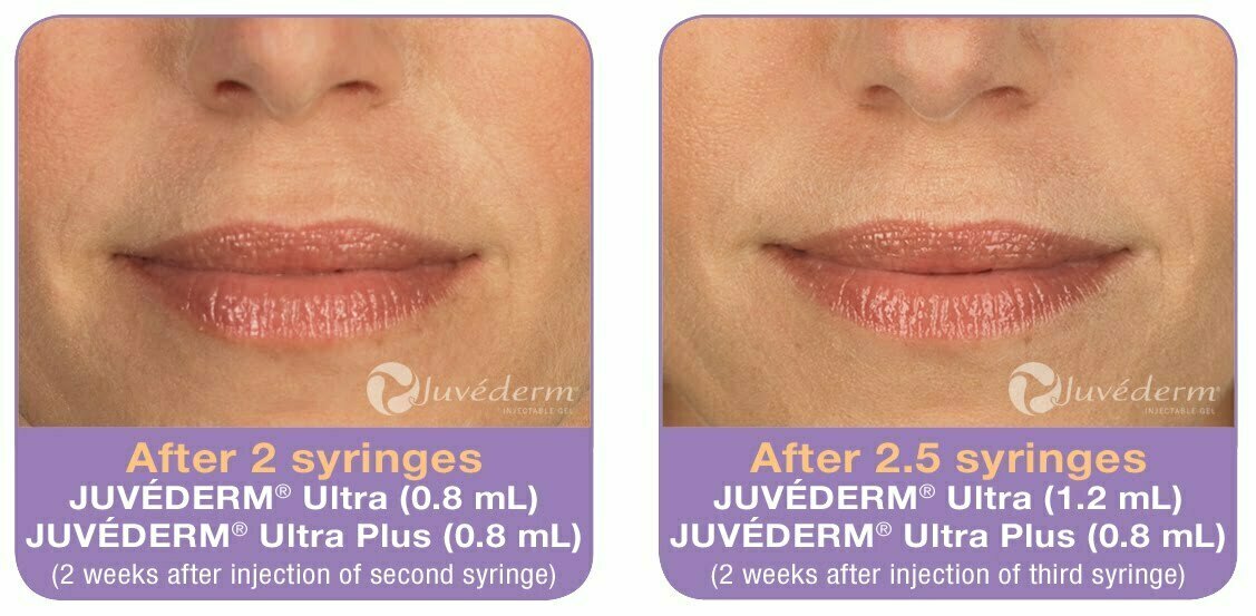 Juvederm & VOLUMA XC Kirby Plastic Surgery Ft. Worth, Texas