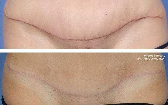 Tummy tuck scar before and after using Embrace to reduce scarring by relieving tension at the site of the incision along the lower abdomen, above the pubic bone. The scar is flattened and fading to match the patient's skin tone, and will continue to fade. Compression garments and drain tubes can also help, if your doctor recommends them, to promote a healthy healing process.