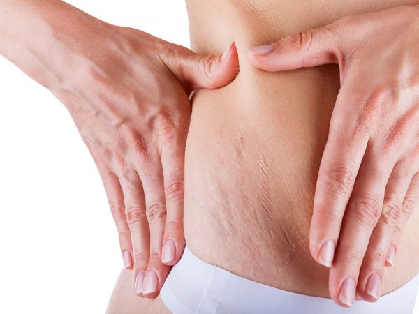 the-truth-about-stretch-marks