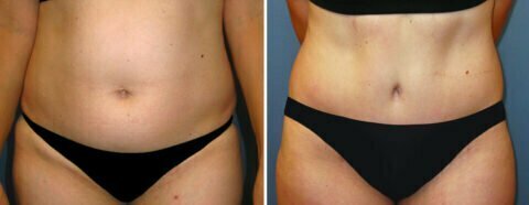 Female patient before and after tummy tuck Fort Worth