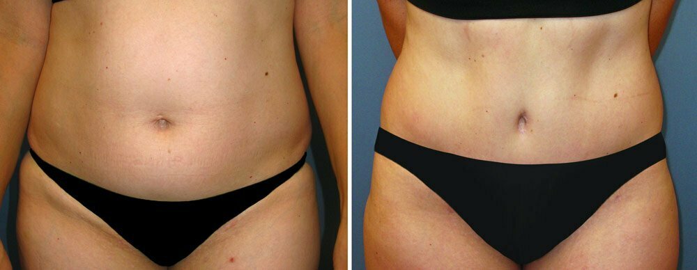 Tummy Tuck G14