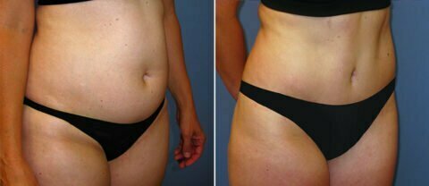 Right side view of female patient before and after abdomen and thigh liposuction Fort Worth