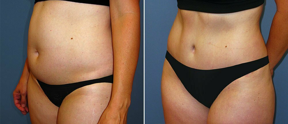 Left side view of female patient before and after abdomen and thigh liposuction Fort Worth