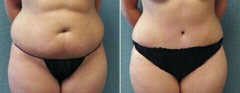 Female patient before and after tummy tuck Fort Worth