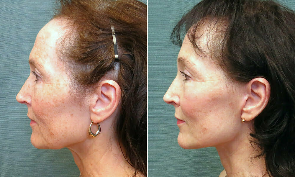 Profile view of female patient before and after eyelid lift and brow lift Fort Worth