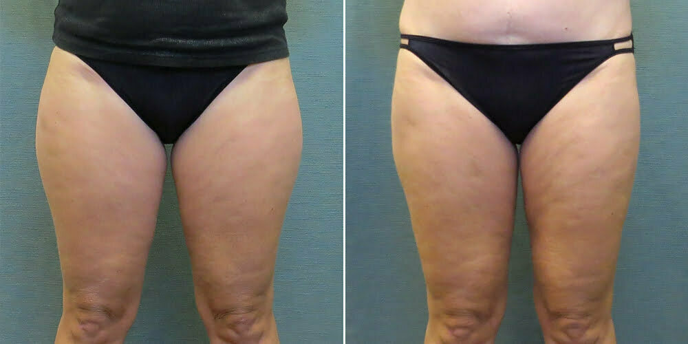 Liposuction G113