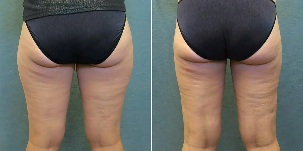 Back view of female patient before and after inner and outer thigh liposuction Fort Worth
