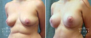 mommy-makeover-08b-breast-lift-aug-kirby