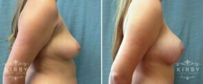 mommy-makeover-08c-breast-lift-aug-kirby