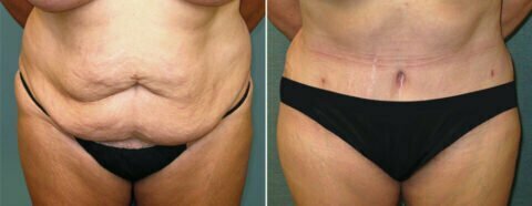 Female patient before and after tummy tuck Fort Worth