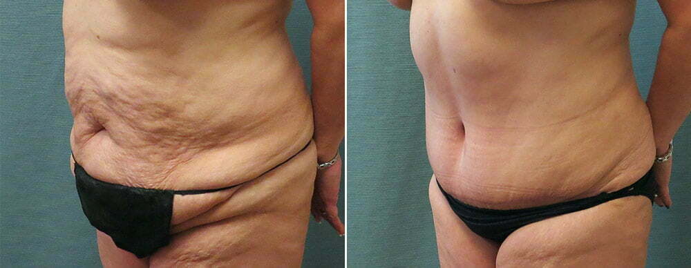 Tummy Tuck G103