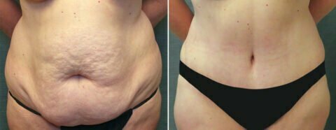 Female patient before and after tummy tuck Fort Worth