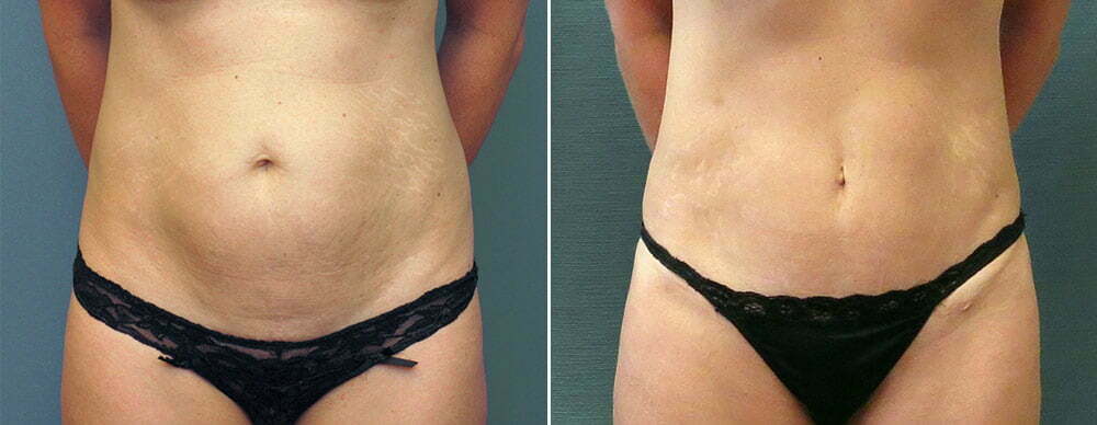 Before and After Mini Tummy Tuck with Dr. Kirby
