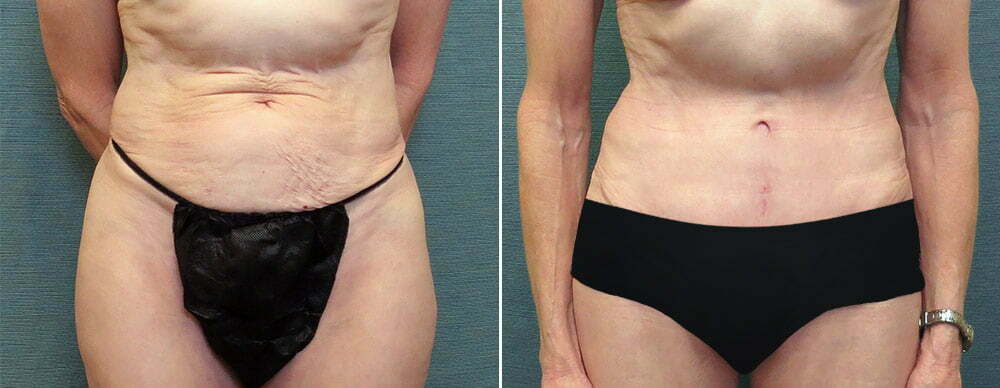 Mini Tummy Tuck G110