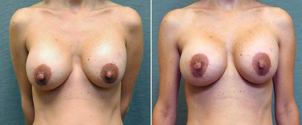 Breast Implant Exchange G125
