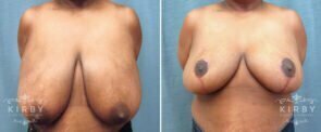 breast-reduction-19a-kirby-wm