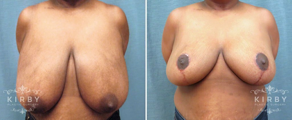 Breast Reduction G119