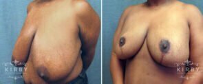 breast-reduction-19b-kirby-wm