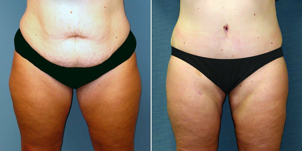 Liposuction Patient G15