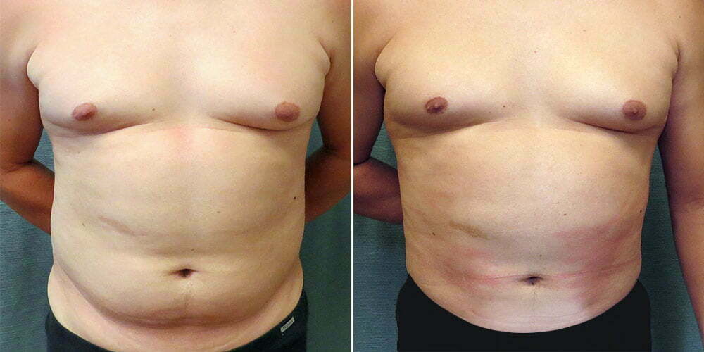 Liposuction G111