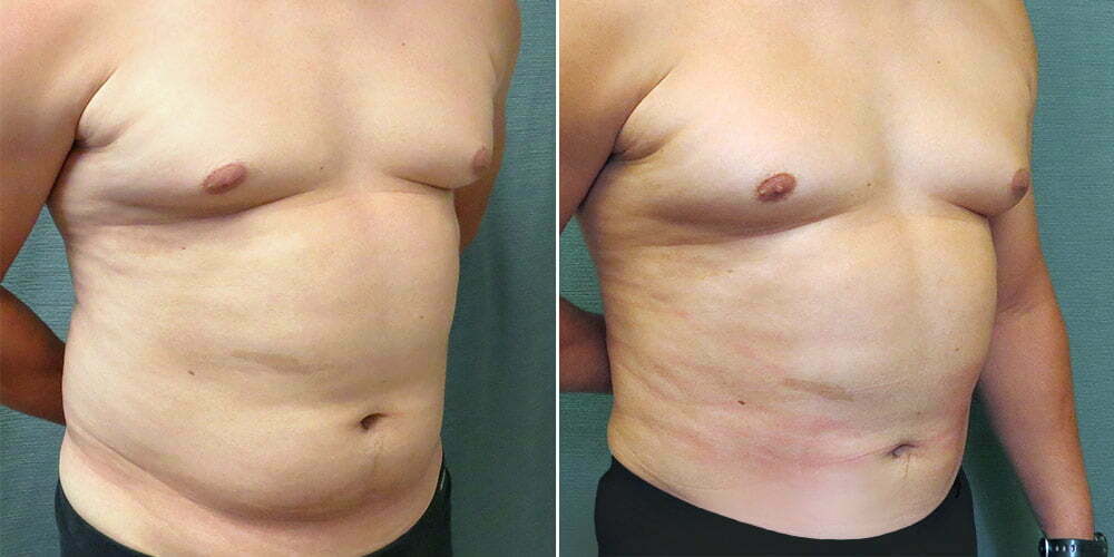 liposuction-11b-left