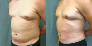 liposuction-11b-male