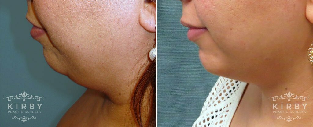 Neck Liposuction G130