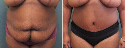 Female patient before and after tummy tuck Fort Worth