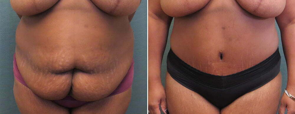 Tummy Tuck G119