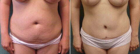Female patient before and after tummy tuck Fort Worth
