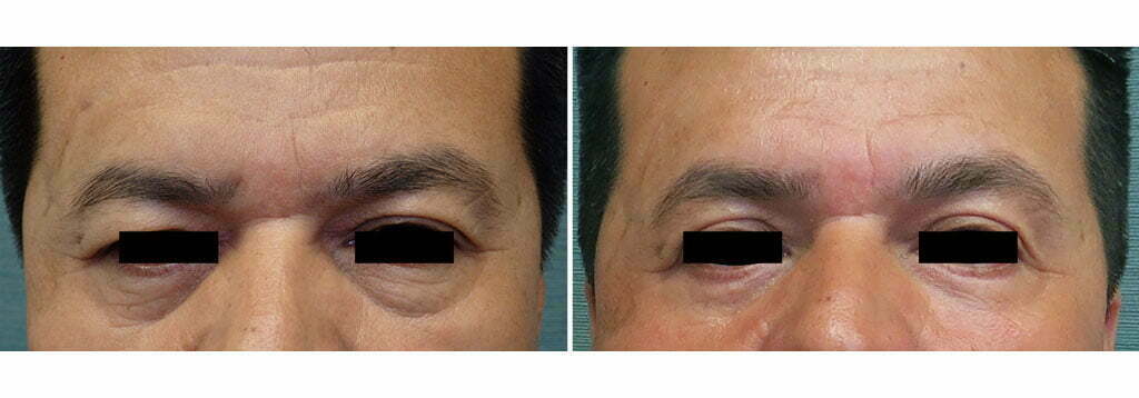 Eyelid Surgery G1101