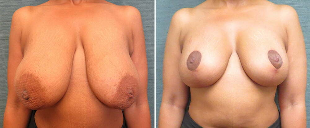 Breast Augmentation with Lift Patient G1119
