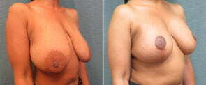 breast-lift-with-augmentation-119b-kirby