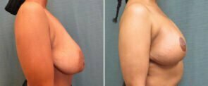 breast-lift-with-augmentation-119c-kirby