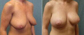 breast-lift-with-augmentation-125b-kirby