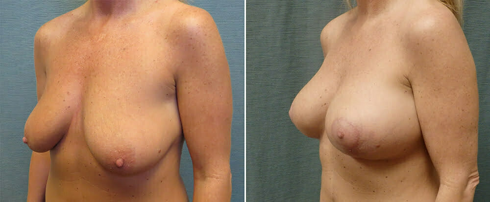 breast-lift-with-augmentation-125c-right-kirby