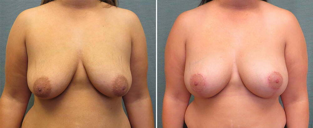 Breast Augmentation with Lift G165