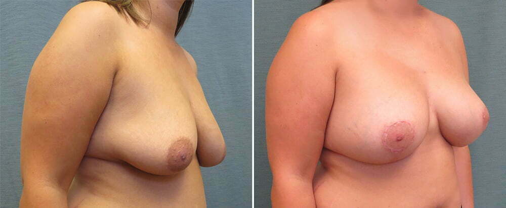 breast-lift-with-augmentation-65b-kirby