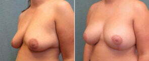 breast-lift-with-augmentation-65b-right-kirby