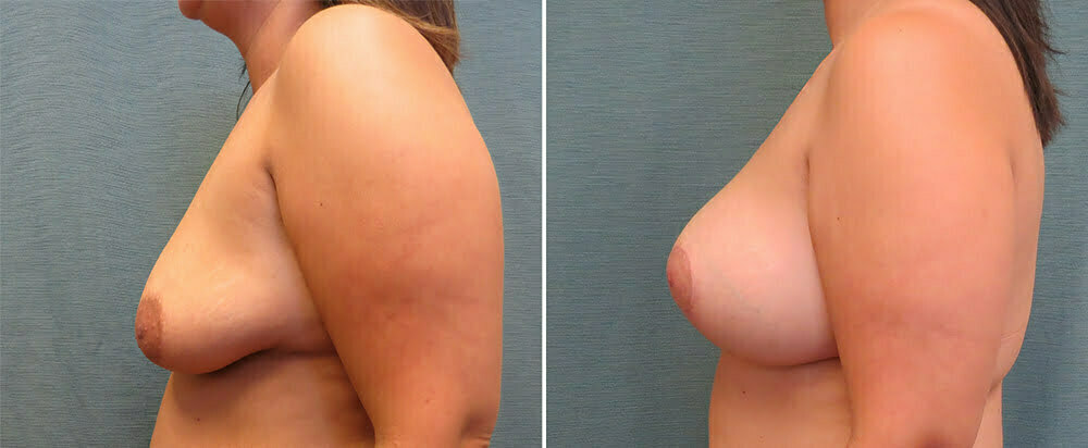 breast-lift-with-augmentation-65c-right-kirby