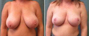 breast-reduction-116a-kirby