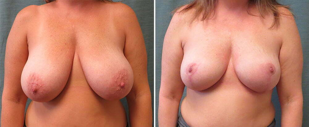 Breast Reduction G1116