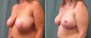 breast-reduction-116b-kirby