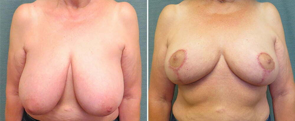 breast-reduction-122a-kirby