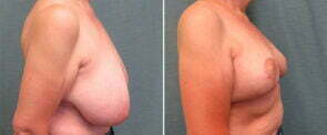 breast-reduction-122c-kirby