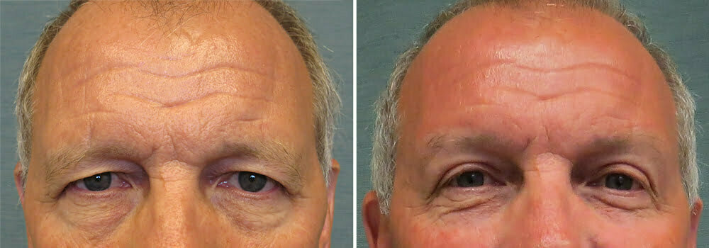 Eyelid & Browlift G1105