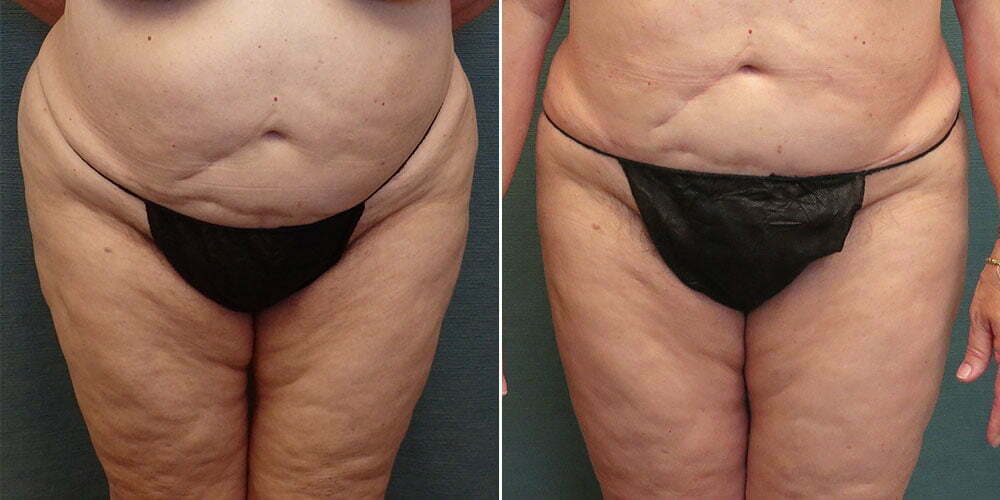 liposuction-97-a-kirby