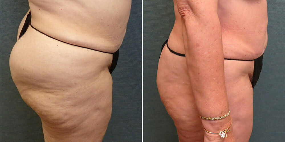 Liposuction G197