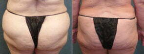 liposuction-97d-kirby