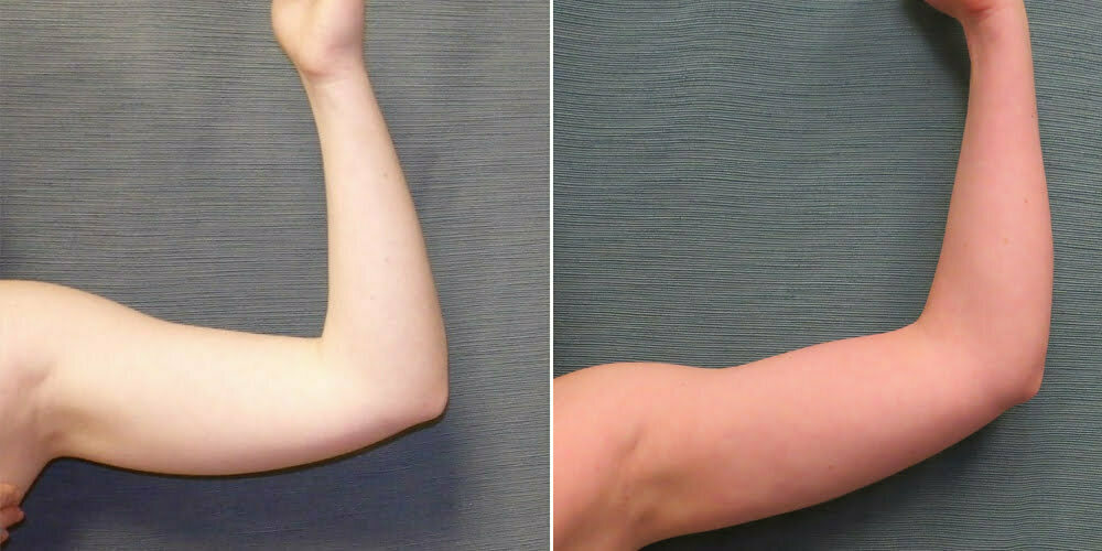 Arm Liposuction G1118